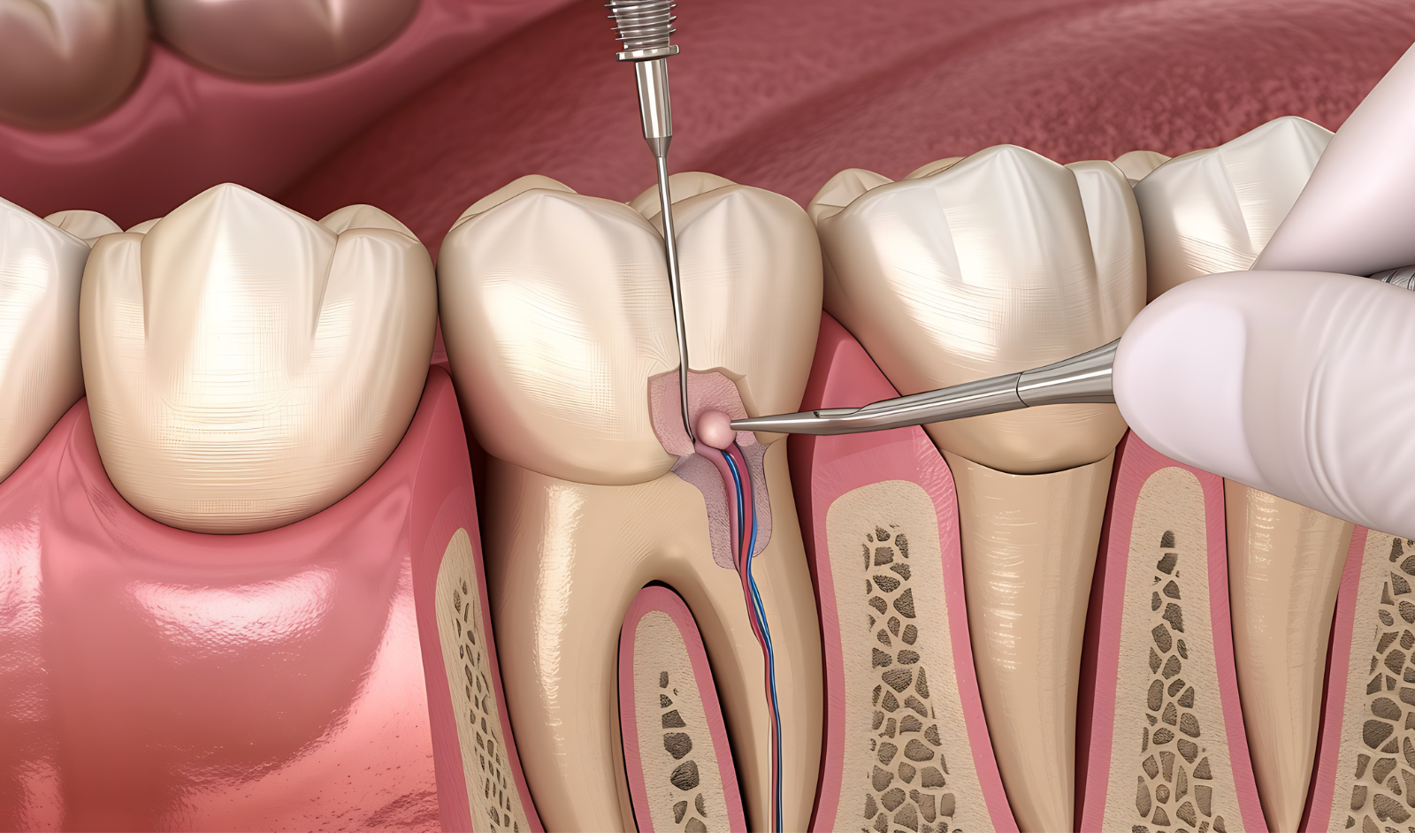 root canal web