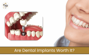 Are Dental Implants Worth It? Pros and Cons Explained