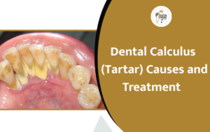 Dental Calculus (Tartar): Causes, Symptoms & Simple Treatment Guide