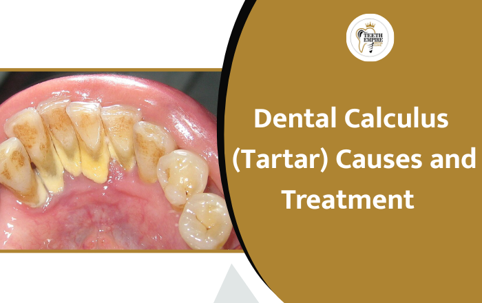 Dental Calculus (Tartar): Causes, Symptoms & Simple Treatment Guide