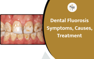 Dental Fluorosis: Symptoms, Causes, and Treatment Options Explained