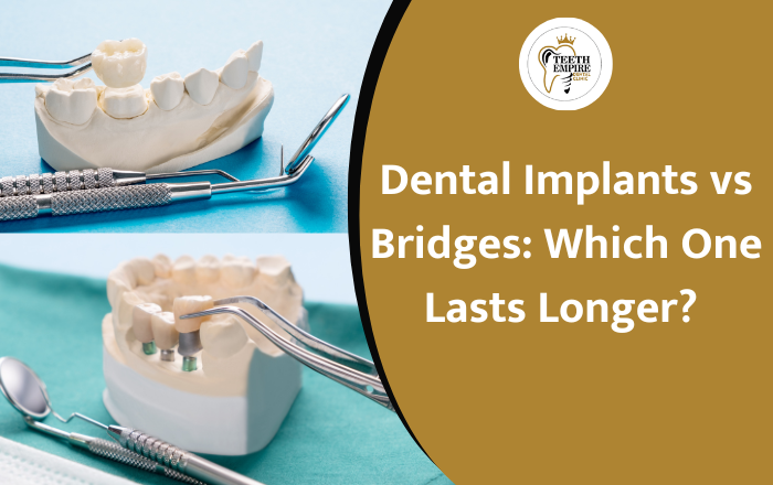 Dental Implants vs Bridges