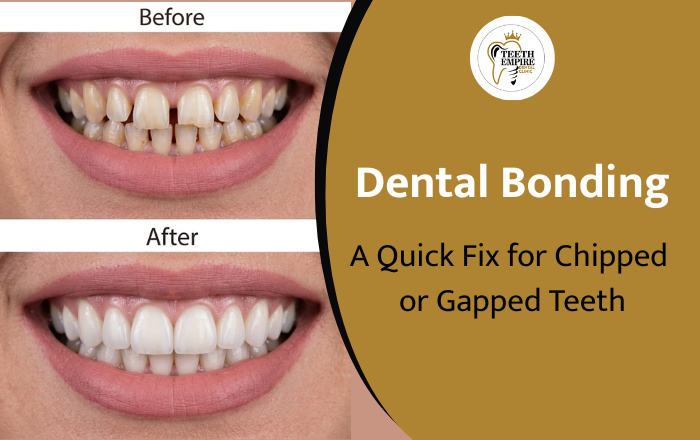 Dental Bonding: A Quick Fix for Chipped or Gapped Teeth