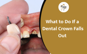 What to Do If a Dental Crown Falls Out