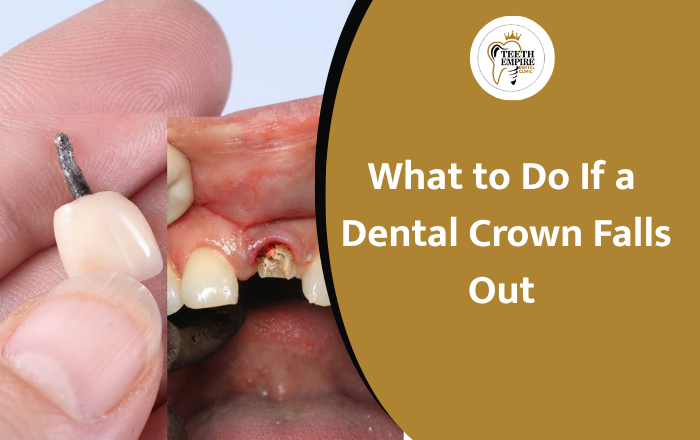 What to Do If a Dental Crown Falls Out