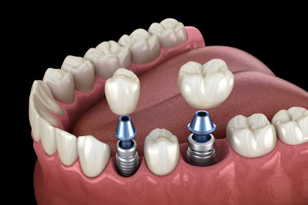 Dental Implants in Kharadi | Teeth Empire Dental Clinic