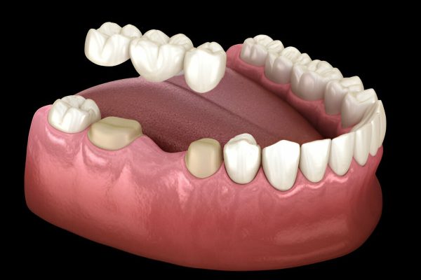 Fixed Teeth crown & Bridge