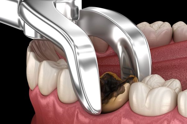 Tooth Extractions & Gum Surgeries